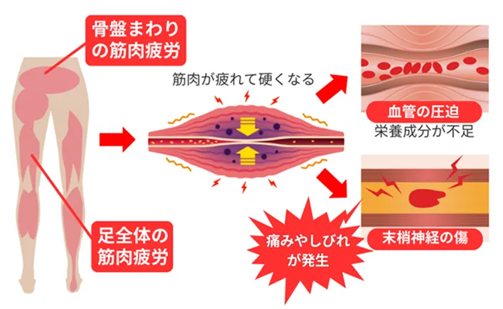 骨盤周りの筋肉疲労・足全体の筋肉疲労で血管が圧迫され末梢神経に傷つき痛みや痺れが発生