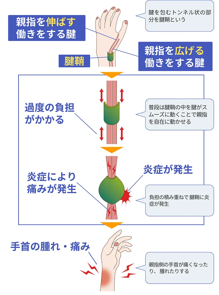 腱鞘に過度な負担がかかり、痛みや痺れが発生