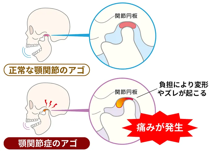 関節円板に強く負担がかかり痛みが発生