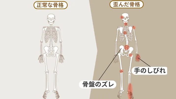 正常な骨格と歪んだ骨格のイラスト