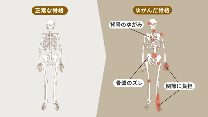 構造（姿勢・骨格のズレ）
