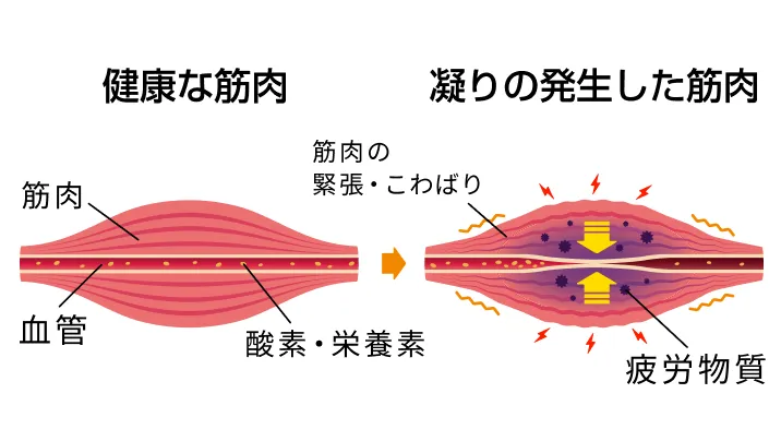 筋肉（筋膜のこわばり）