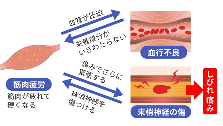 筋肉疲労により血管が圧迫・末梢神経が木津付きしびれや痛みが発生
