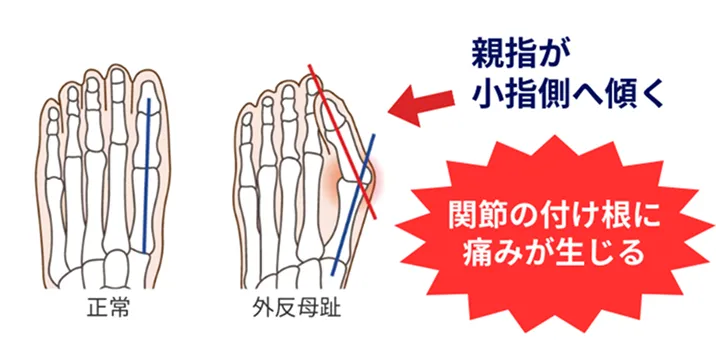 親指が小指側へ傾く