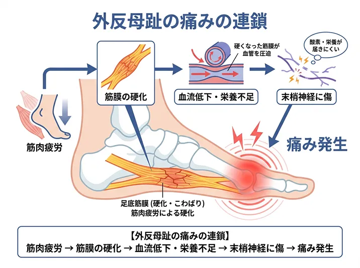外反母趾の痛みの連鎖