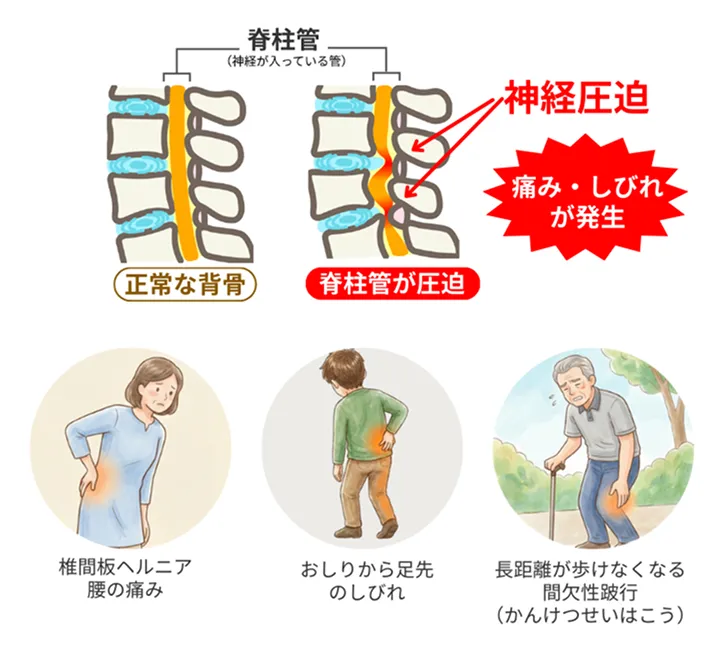脊柱管の神経が圧迫されて痛みや痺れが発生